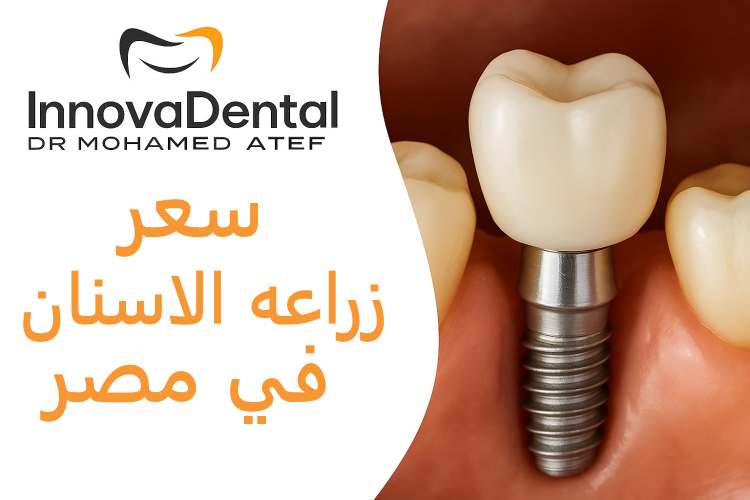 Price Of Dental Implants In Egypt 2025
